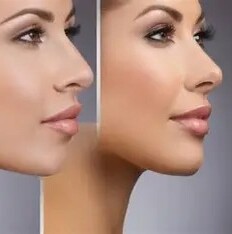 Chin Augmentation 1-2 ml