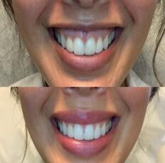Gummy Smile