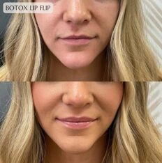 Lip Flip