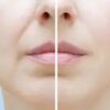 Nosolabial folds Nasolabial Folds 1 - 2 ml