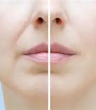 Nasolabial Folds  1 - 2 ml