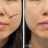 OIP (4) Nasolabial Folds 1 - 2 ml
