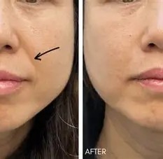 OIP (4) Nasolabial Folds 1 - 2 ml