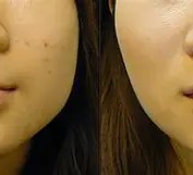 Masseter / Slimmer Face 1 - 2 ml