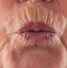 Smoker's Lip Lines