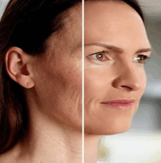 Upper Face 3 areas (forehead, frown and crows feet)