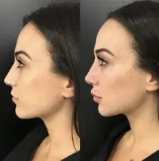 Cheeks Augmentation or Cheeks Shape and Contour     1 -2 ml