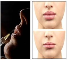 Lip Augmentation  1 - 2 ml